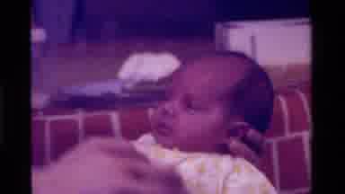 California USA (1975): neborn baby with male pattern balding