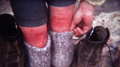1972: Women pulling down socks to show off red chigger insect bites.